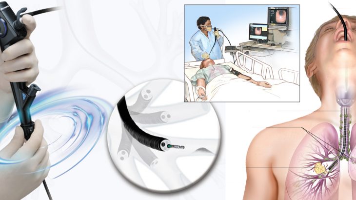 bronchoscopy1