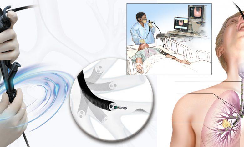 bronchoscopy1