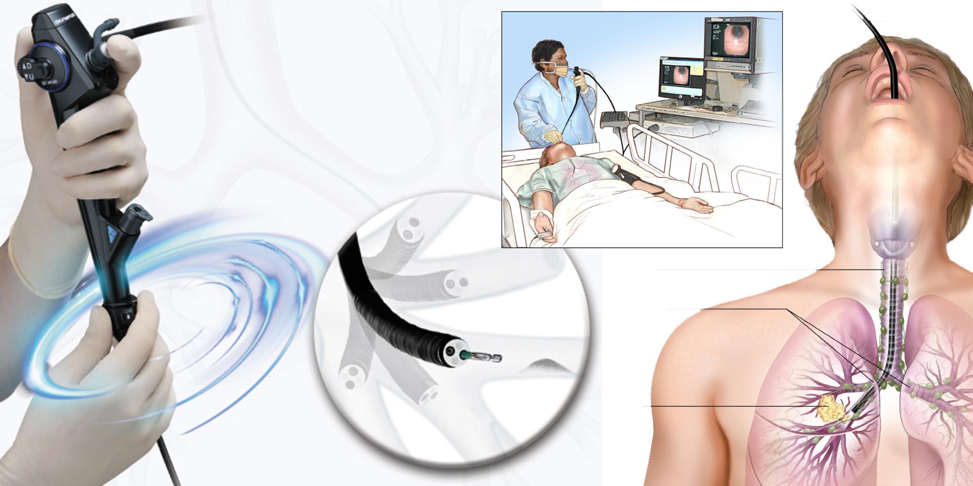 برونکوسکوپی چیست؟ روند انجام برونکوسکوپی چگونه است؟ 1 bronchoscopy1